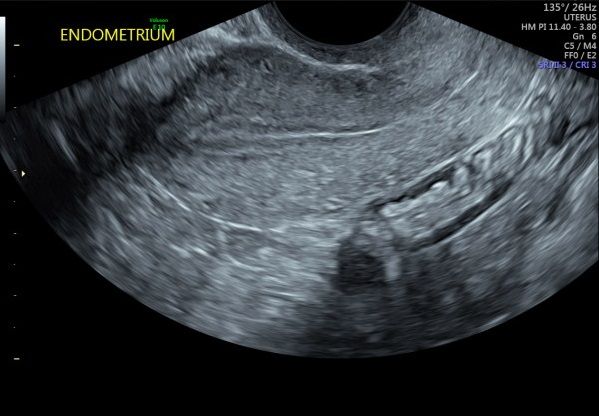 Proliferative endomtrium