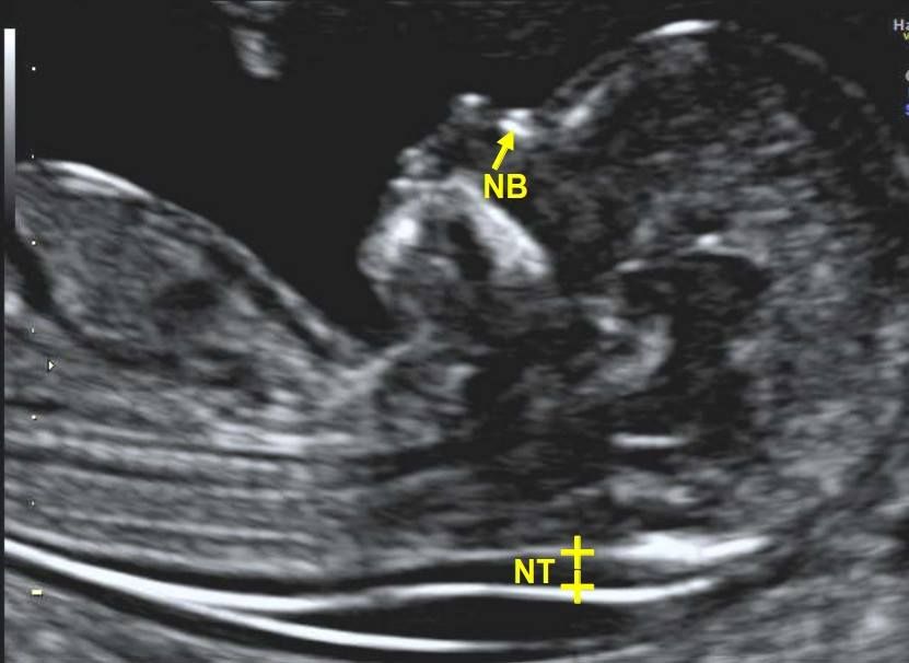 Nuchal Translucency and Nasal Bone